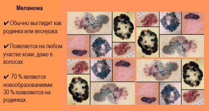 Melanomul Etapa 4 Prognoza vieții