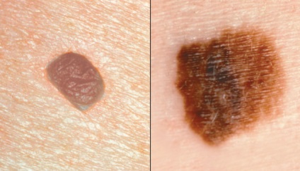 Melanomul Etapa 4 Prognoza vieții