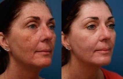 Peeling de migdale pentru recenzii de față, fotografii înainte și după
