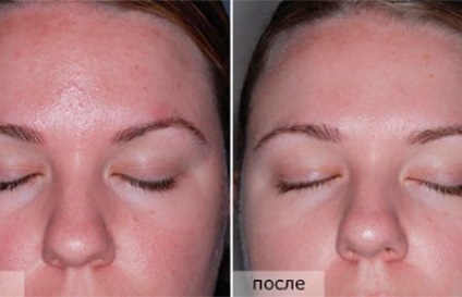 Peeling de migdale pentru recenzii de față, fotografii înainte și după