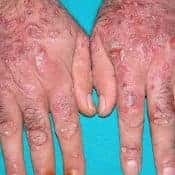 Dermatita nervoasa Simptome si tratament