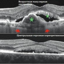 Tomografia coerentă optică a retinei - clinica Fedorov