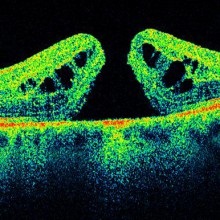Tomografia coerentă optică a retinei - clinica Fedorov