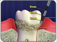 Definirea parodontologică a sondei, funcții și tipuri