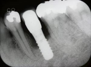 Pereimplantitis simptome și tratament, preturi, fotografii