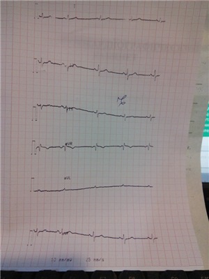 Cardiograma slabă (conform cererii asistentului de laborator), simptome de anxietate, 4 răspunsuri, 7 comentarii,