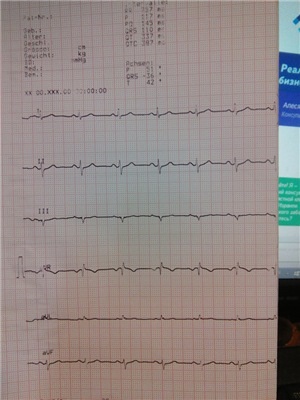 Cardiograma slabă (conform cererii asistentului de laborator), simptome de anxietate, 4 răspunsuri, 7 comentarii,