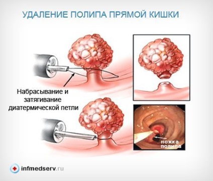 Polipi ai rectului, simptome și tratament - viața mea