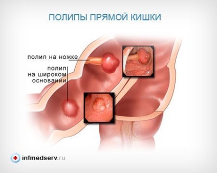 Polipi ai rectului, simptome și tratament - viața mea