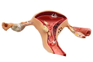 Polipii în uter, cauze, simptome și tratament