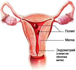 Polipoză endometrială, medicină intimă din