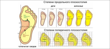 Simptomele picioarelor plate la copiii cu simptome și grad de boală