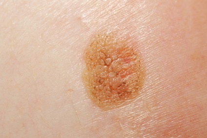 A bőr melanomájának előrejelzései: a várható élettartam, a relapsusok százalékos aránya, a teljes gyógymód