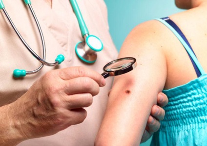 Prognozele pentru melanomul pielii ce speranță de viață, procentul recidivelor, leacul complet pentru