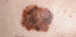 Prognozele pentru melanomul pielii ce speranță de viață, procentul recidivelor, leacul complet pentru