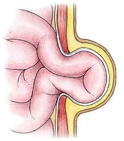 Hernia ombilicală