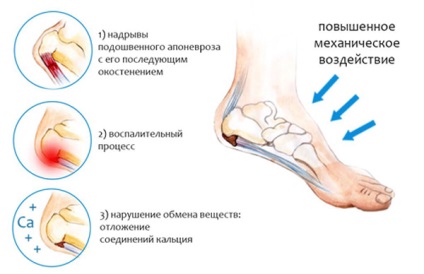 Heel го и шпори как да се отнасяме