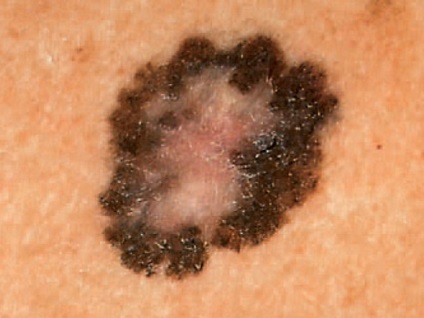 Bőrrák - basalis sejtkarcinóma, melanoma tünetek és jelenségek, hogyan néz ki, hogy hány élő -