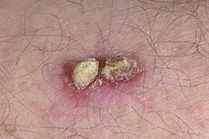 Bőrrák - basalis sejtkarcinóma, melanoma tünetek és jelenségek, hogyan néz ki, hogy hány élő -