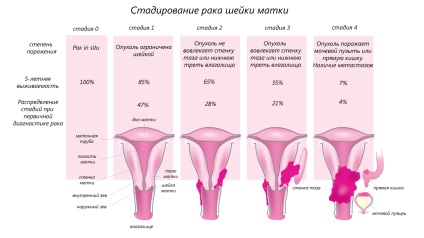 Stadiul și tratamentul cancerului de col uterin