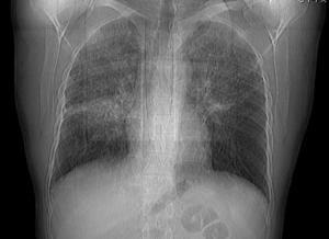 Sarcoidosis - a sarcoidosis okozta okok, tünetek és népi gyógymódok