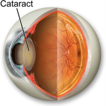 Simptomele cataractei oculare, metode de tratament