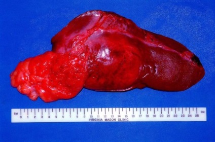 Chistul solitar al rinichiului 6 simptome importante, complicații, tratament