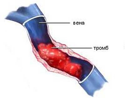 Az alsó végtagok mélyvénás tromboflebitisének kezelése és okai