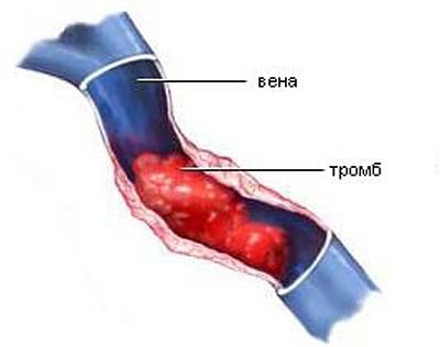 Тромбофлебіт глибоких вен нижніх кінцівок лікування і причини