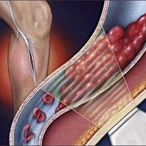 Tromboflebita venoasă profundă a tratamentului și a cauzelor extremităților inferioare