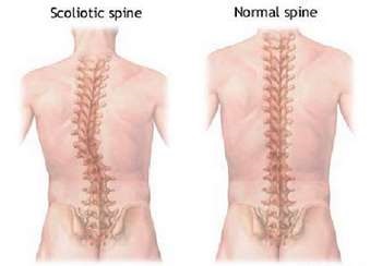 Exerciții pentru spate în scolioză