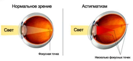 Tipurile de astigmatism, gradele și tipurile de clasificare