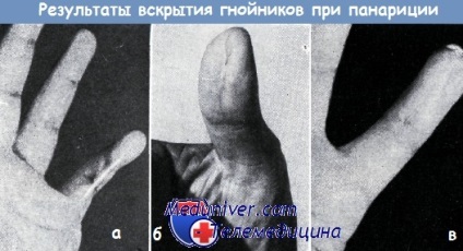 Autopsia abcesului mâinii în timpul panaritiului (inflamație purulentă)