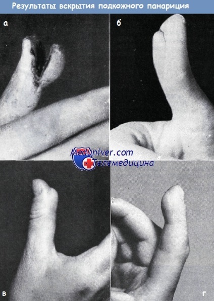 A kéz tályogának boncolása a panárium alatt (gümős gyulladás)
