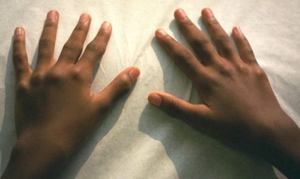 Artrita reumatoidă juvenilă cauzează, simptome, tratament și prevenire