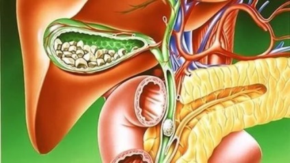 Tratamentul bolii biliari (zhkb) fără intervenție chirurgicală, dietă