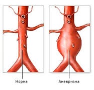 Anevrismul cauzelor și tratamentului arterei splenice