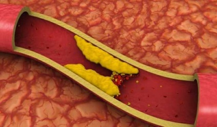Anevrismul arterei splenice provoacă dezvoltarea, tratamentul și prevenirea