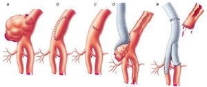 Artériás aneurysma tünetek, diagnózis és kezelés