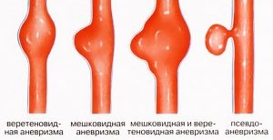 Artériás aneurysma tünetek, diagnózis és kezelés