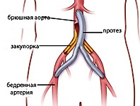 Аорто-стегнової шунтування, хірургія, судинна хірургія