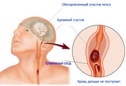 Arforminoase malformații ale vaselor cerebrale - tratamentul malformațiilor arteriovene în Moscova