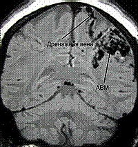 Malformații arteriovenoase (anomalii vasculare cerebrale)