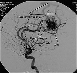 Malformații arteriovenoase (anomalii vasculare cerebrale)