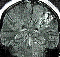 Malformații arteriovenoase (anomalii vasculare cerebrale)