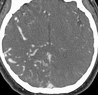 Malformații arteriovenoase (anomalii vasculare cerebrale)