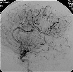 Malformații arteriovenoase (anomalii vasculare cerebrale)