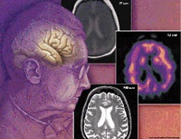 Boala Alzheimer este o cauză obișnuită a morții