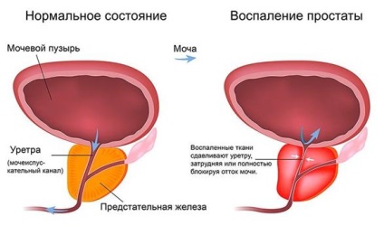 Durere în prostatită la bărbați