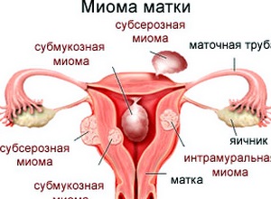 Borovoy proprietăți uterine medicinale și contraindicații